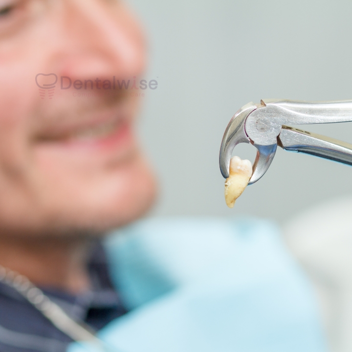Dental Extraction