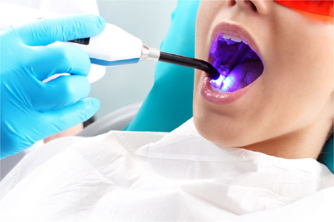 Advanced Laser Assisted RCT