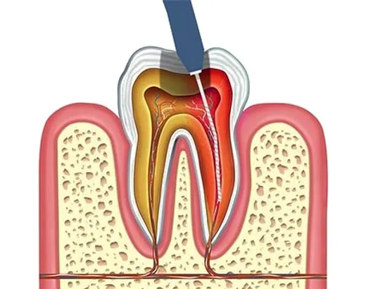 Pulpectomy and Pulpal Therapy