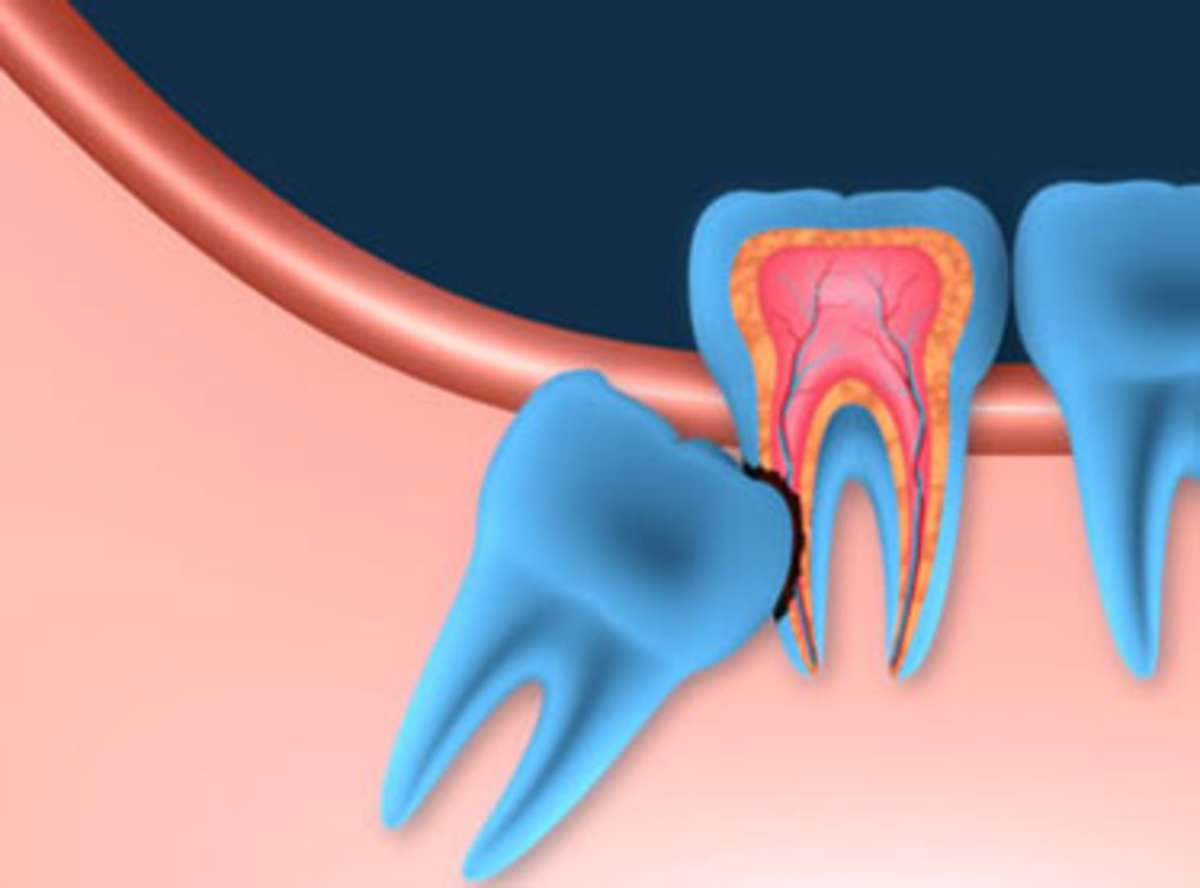 Pain-Free Wisdom Tooth Extraction