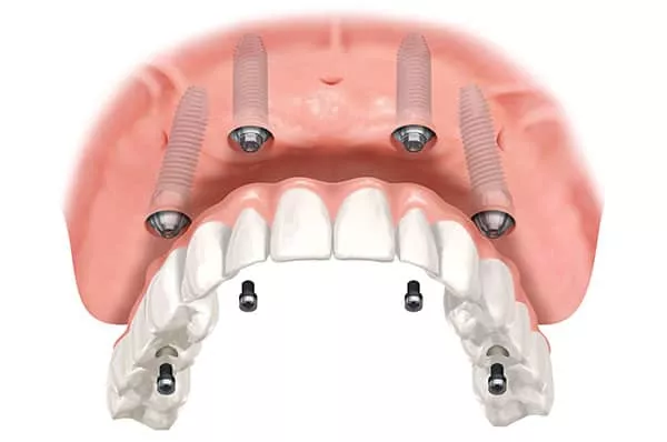 All on 4 and Fixed Dentures