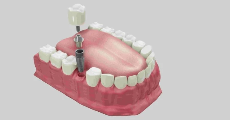 Single Implant Rehabilitation with Lifetime Warranty