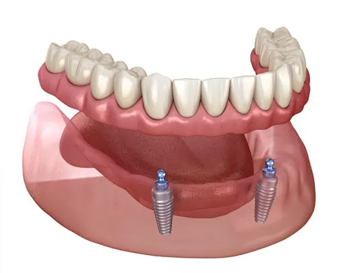 Conventional Dentures