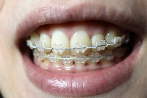 Speciality Orthodontic Appliances & In-house Aligners