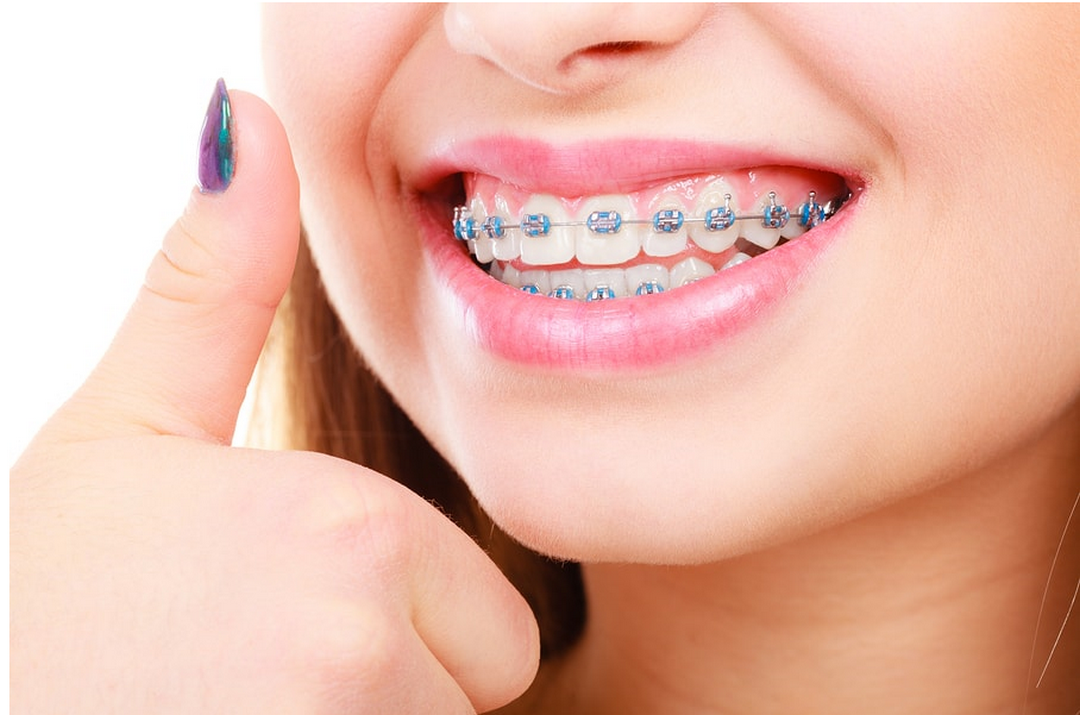 Conventional Orthodontic Treatment System