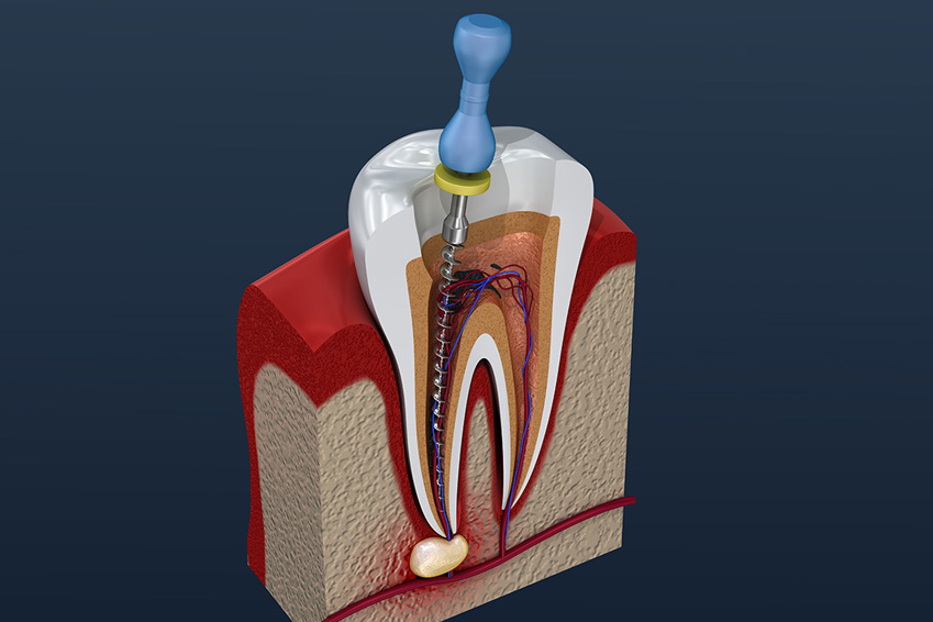 Re-Treatment for Failed Root Canal Process