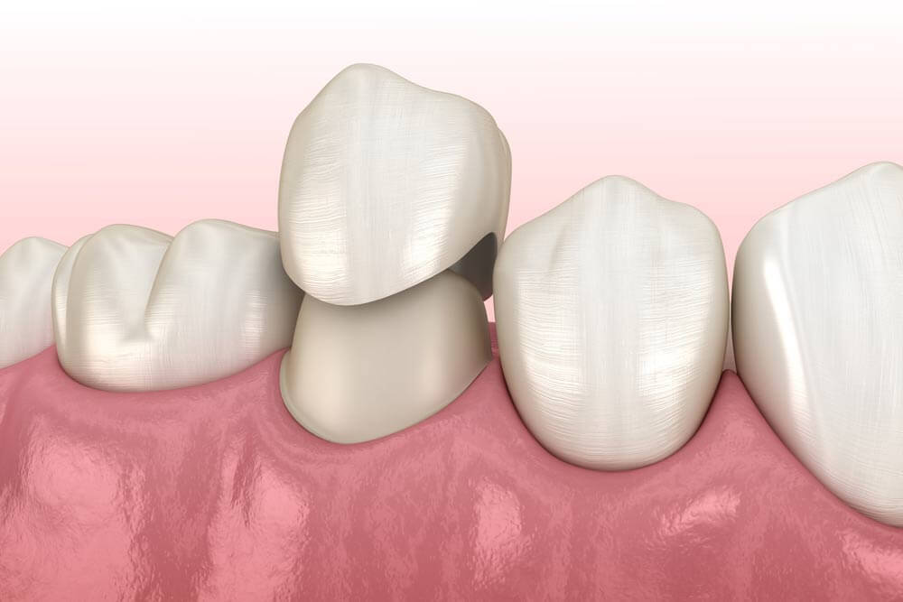 Zirconia Crowns