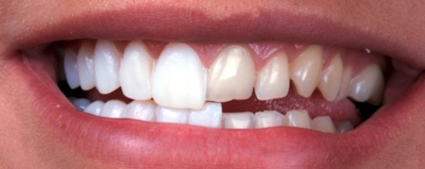 Single Sitting Composite Veneers Transformation